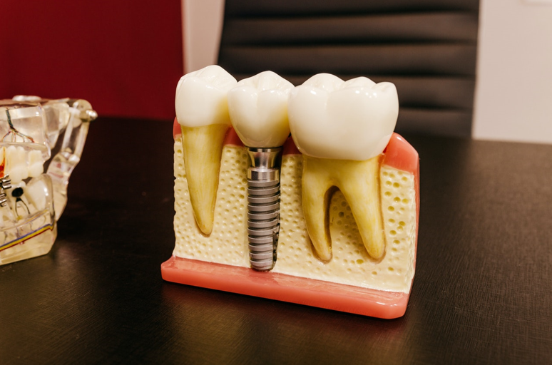 The Impact Of Tooth Loss And How Dental Implants In Harley Street Can Help