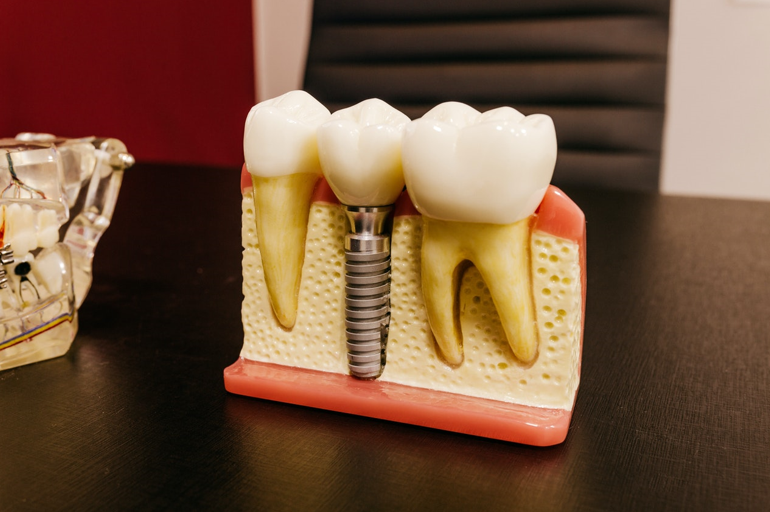 Dental Implants: The Treatment You Need For Achieving A Natural Looking Smile