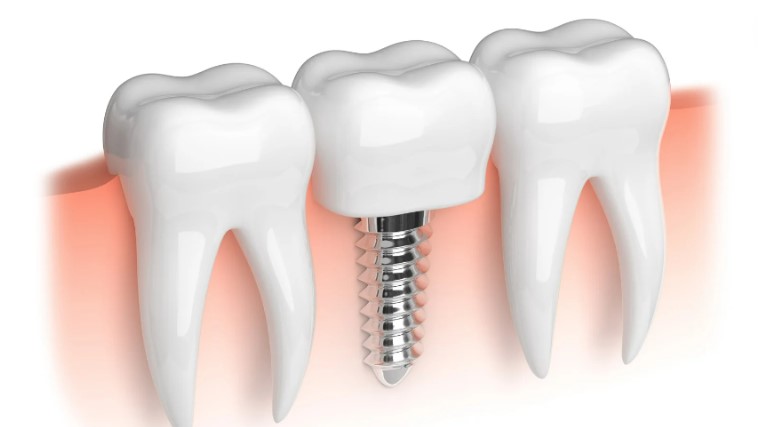 Navigating the Pre- and Post-Operative Phases of Dental Implant Surgery
